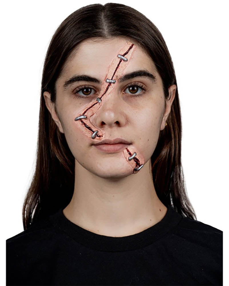 Stapled Woman FX Appliance Transfer Prosthetic