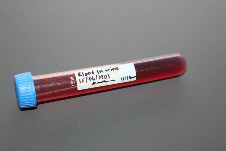 Simulated Blood in Urine Medical Specimen Tube