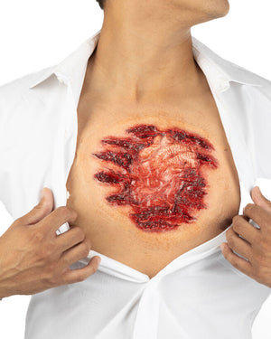 Open Chest FX Appliance Transfer Prosthetic Wound