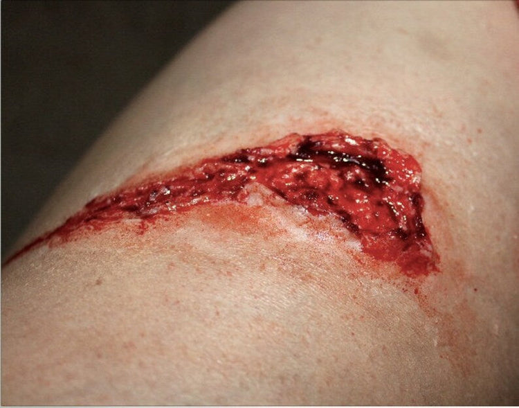 Outdoor Injuries Prosthetic Bundle