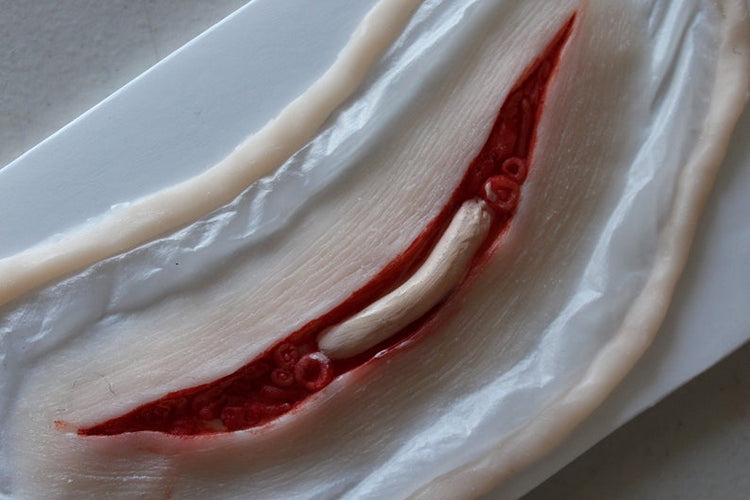 Exposed Slit Throat Prosthetic