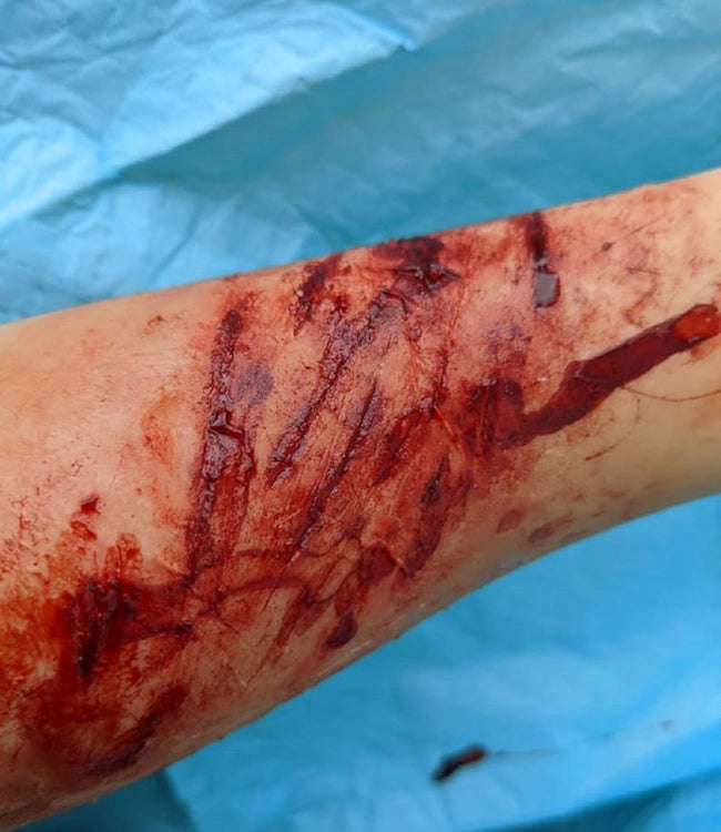 Outdoor Injuries Prosthetic Bundle