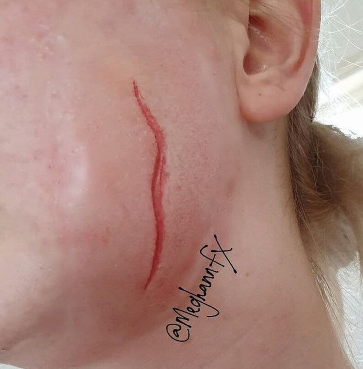 Small Thin Scar Wound Prosthetic