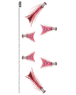 Stretched Skin FX Trauma Tattoo